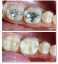 White Fillings - Amalgam free